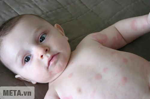 Vi khuẩn ẩm mốc trong quần áo gây ra một số bệnh về da cho trẻ nhỏ