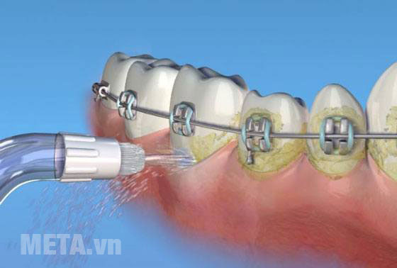 Các tia nước phun ra từ đầu tăm nước có thể làm sạch mảng bám ở mọi vị trí