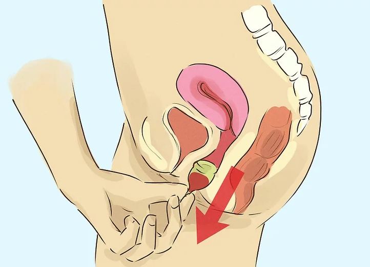 Cách lấy cốc nguyệt san ra ngoài