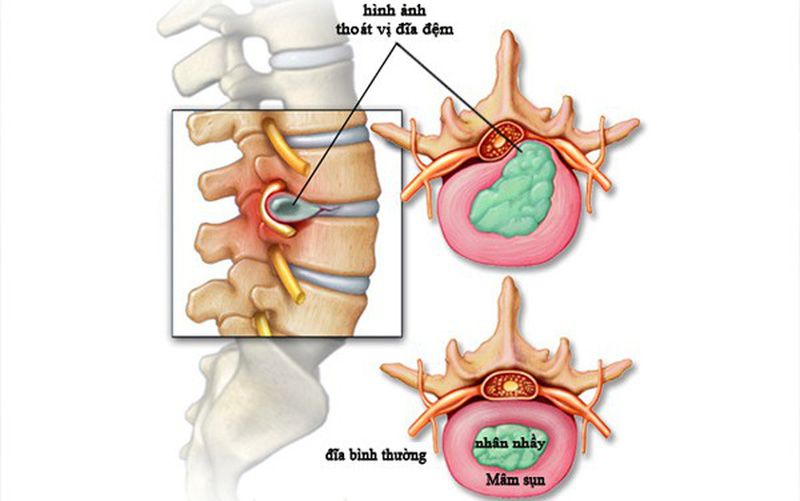 Chữa thoát vị đĩa đệm bằng xà đơn: Phương pháp và những lưu ý quan trọng Mới Nhất