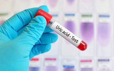 acid uric 