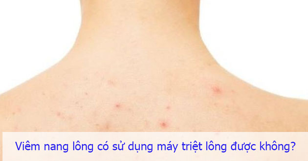 Viêm nang lông có sử dụng máy triệt lông cá nhân được không