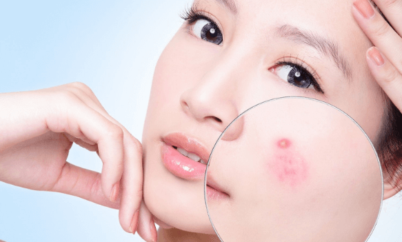 Tinh dầu sả chanh giúp trị mụn hiệu quả