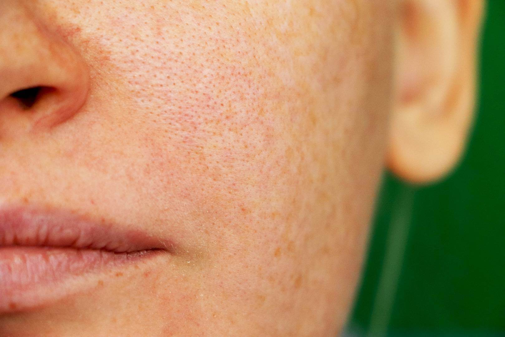 Auckland tempo Formulering Nguyên nhân và cách chăm sóc da mặt sần sùi lỗ chân lông to - META.vn
