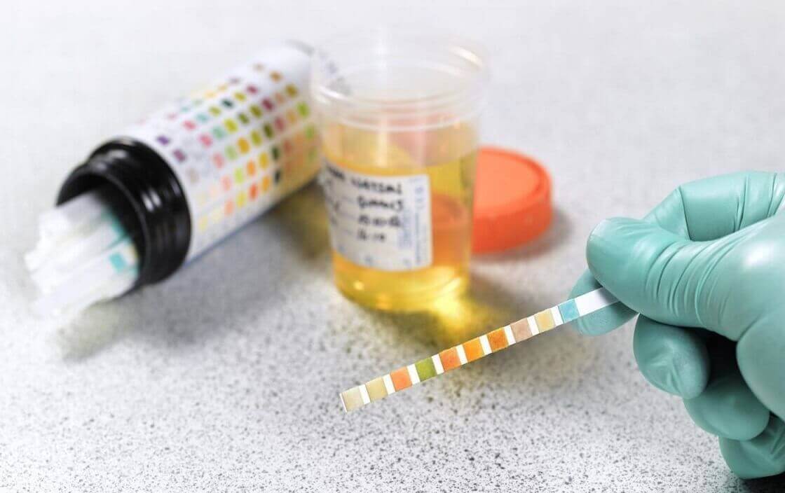 Ý nghĩa chỉ số ketone giúp phát hiện ketone niệu