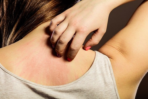 Mùa đông tắm xong bị ngứa có sao không?