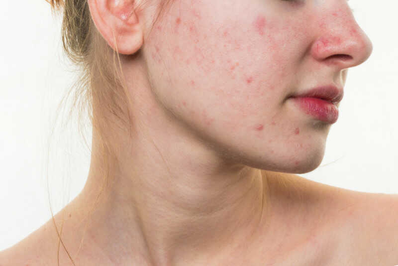 Tác hại của máy hút mụn