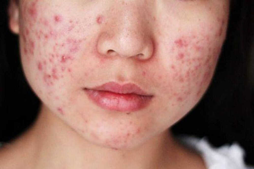Dùng máy hút mụn có hại không?