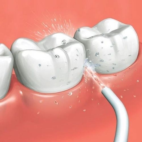 Máy tăm nước loại bỏ thức ăn thừa và mảng bám ở kẽ răng hiệu quả