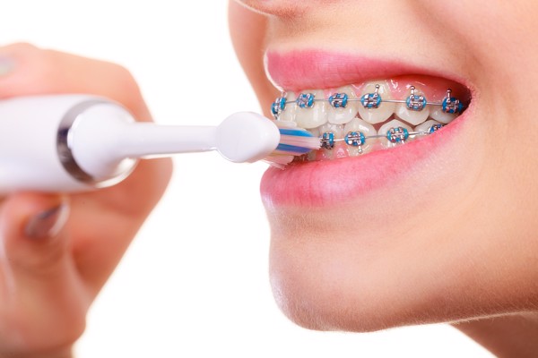 Hướng dẫn vệ sinh răng miệng khi niềng răng