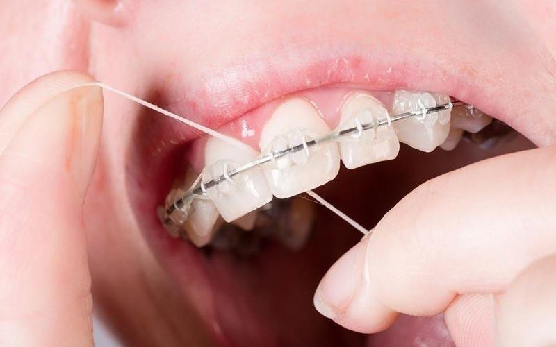 Cách chăm sóc răng miệng khi niềng răng