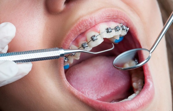 Lưu ý cách vệ sinh răng khi đeo mắc cài