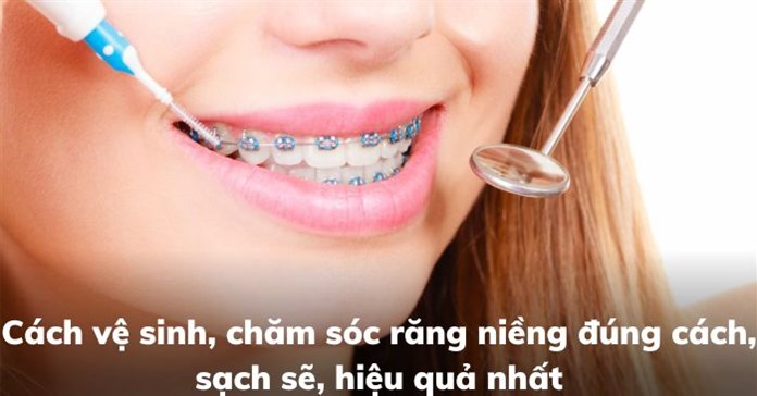 Cách vệ sinh, chăm sóc răng niềng đúng cách, sạch sẽ, hiệu quả nhất