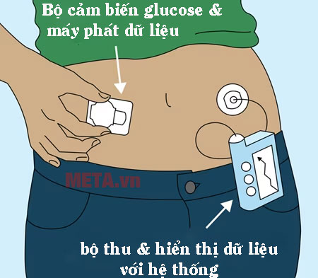 Cấu tạo và cơ chế hoạt động của máy đo đường huyết liên tục