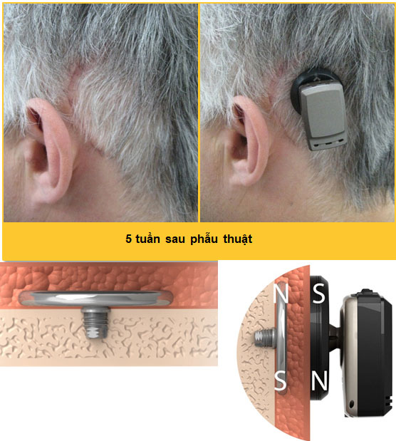 Máy trợ thính nghe qua đường xương