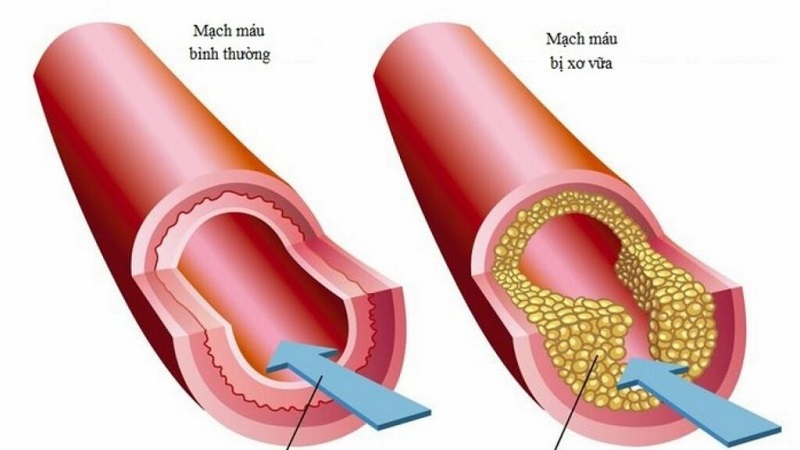 Chênh lệch huyết áp 2 tay thế nào là bất thường?