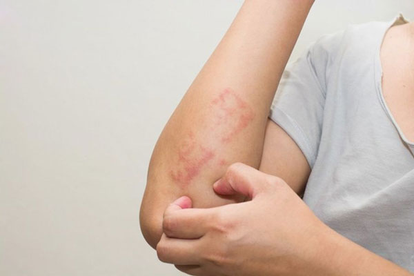 Tác hại của máy sưởi dầu có thể gây bỏng rát nếu không sử dụng đúng cách
