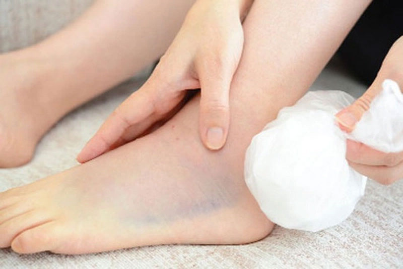 Bị ngã, sưng chân chườm nóng hay lạnh?
