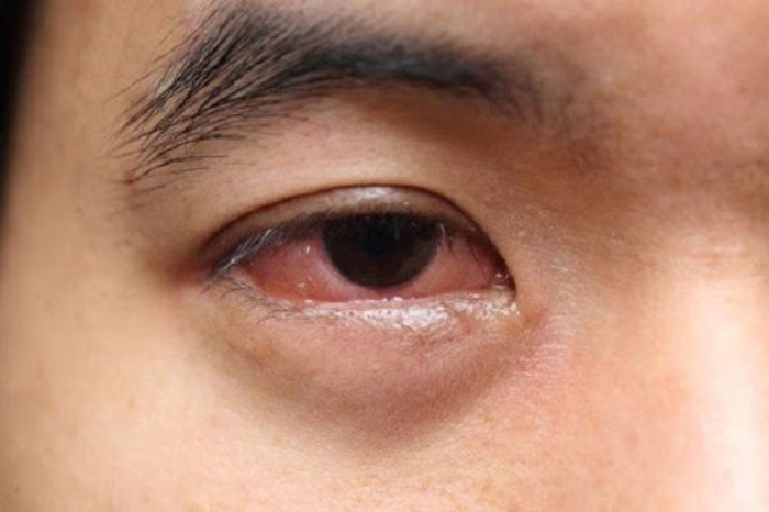 Đau mắt hàn là gì?